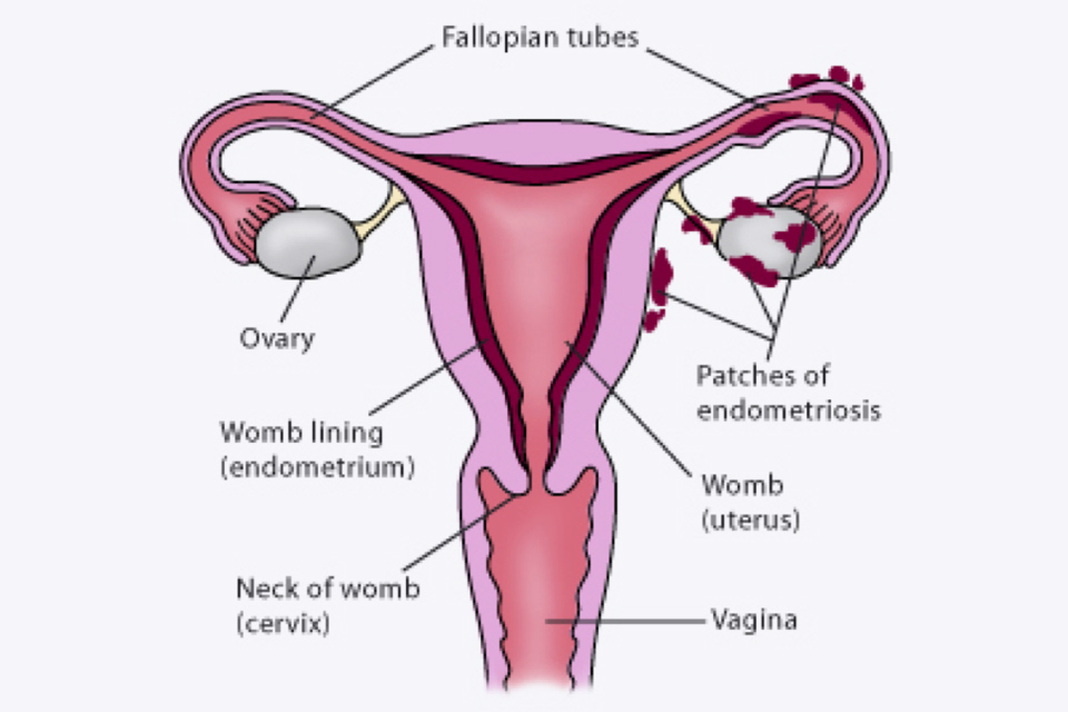 Endometriosis diagram