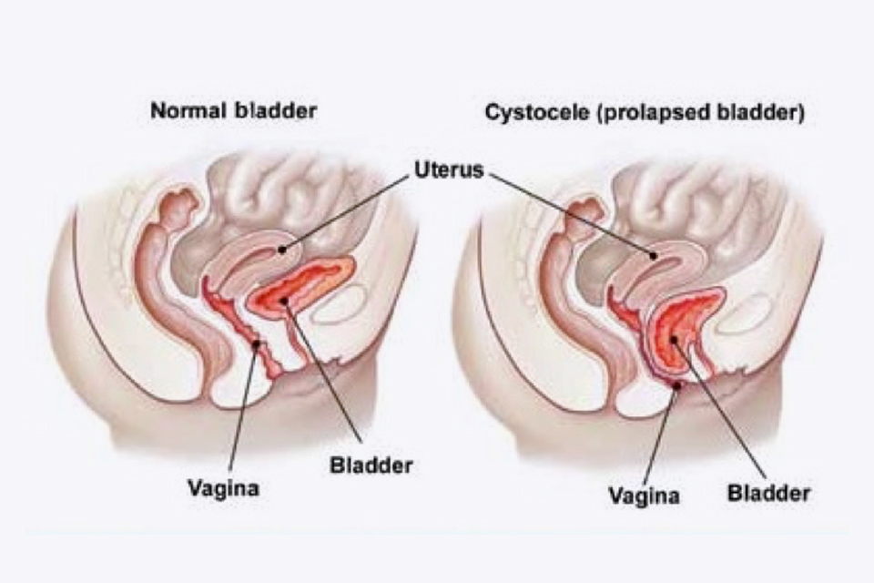 Urinary incontinence and vaginal prolapse after vaginal delivery