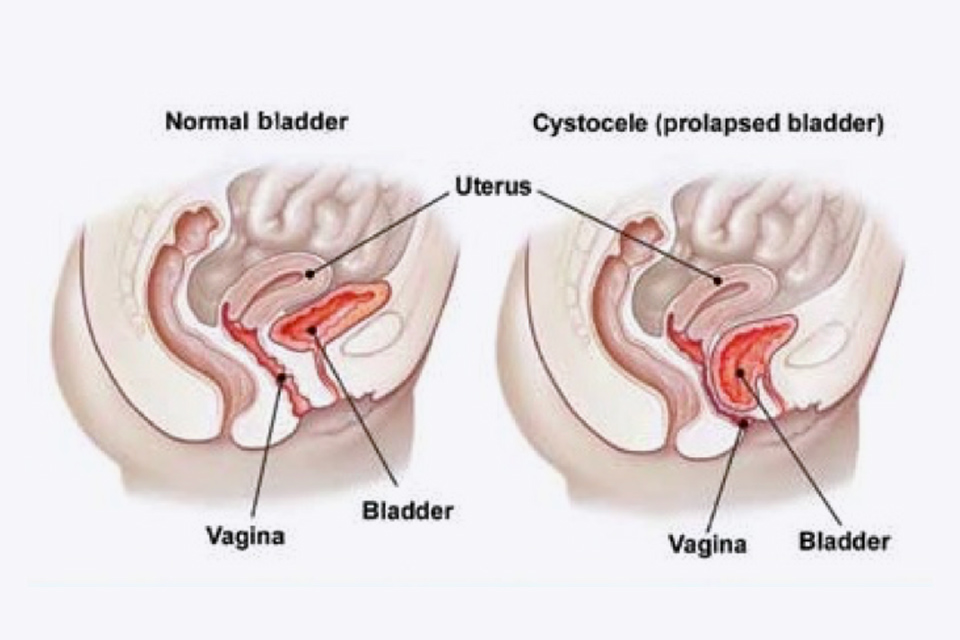 Uterine prolapse. (left) Lateral view of pelvis showing normal