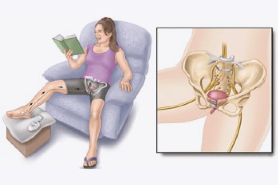 Posterior Tibial Nerve Stimulation (PTNS)