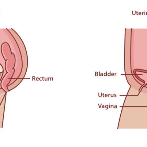 Mild Uterine Prolapse Explained