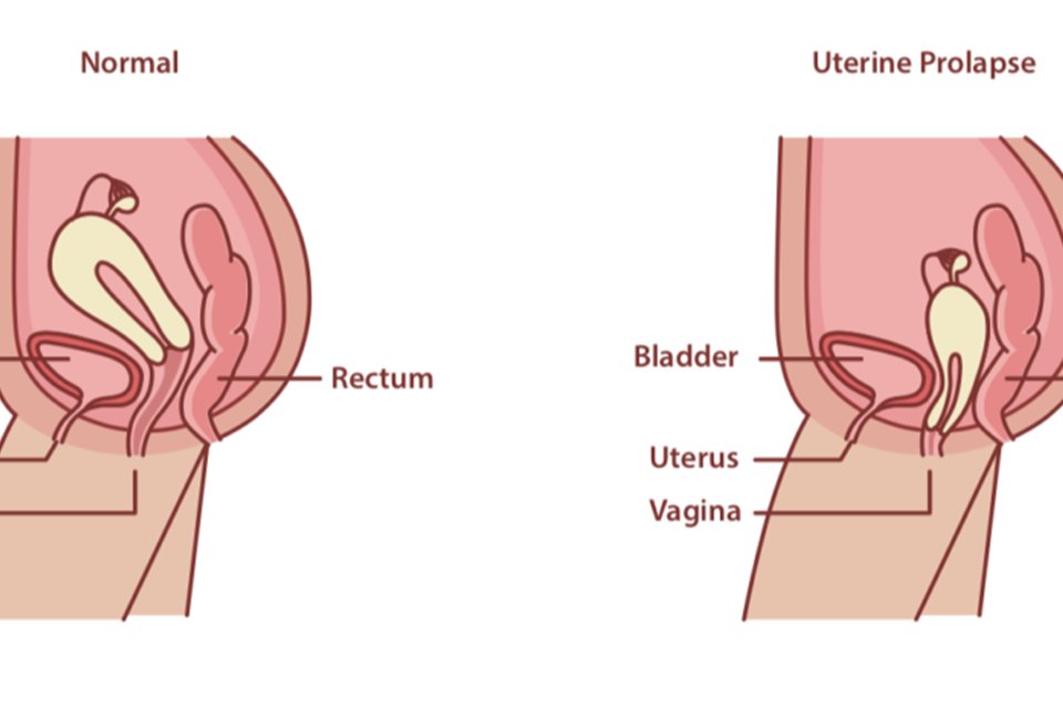 Mild Uterine Prolapse Explained