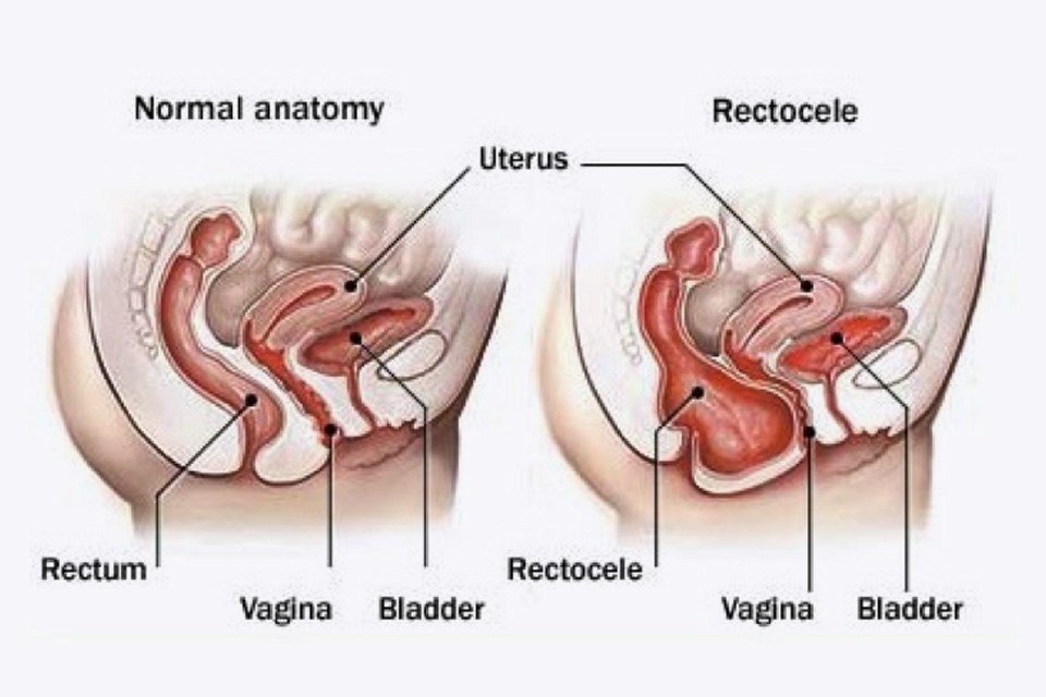 The prolapsed bladder was pushed back to the abdominal cavity through