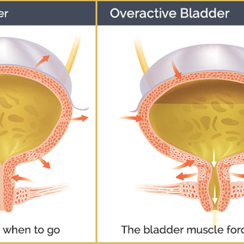 Can You Treat an Overactive Bladder?