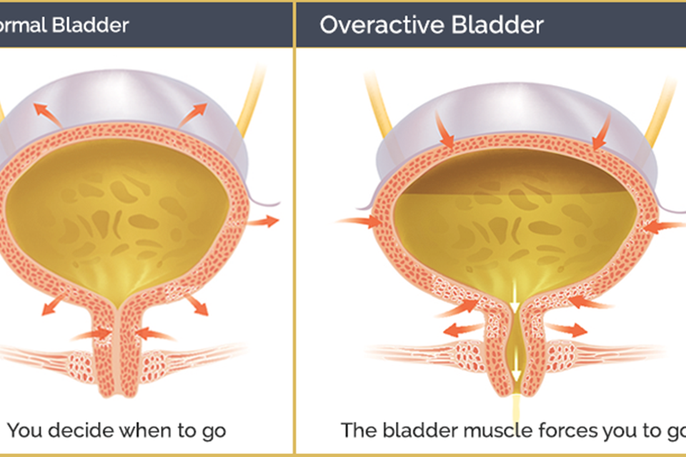 Can You Treat an Overactive Bladder?