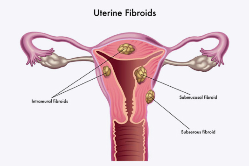 Fibroids diagram