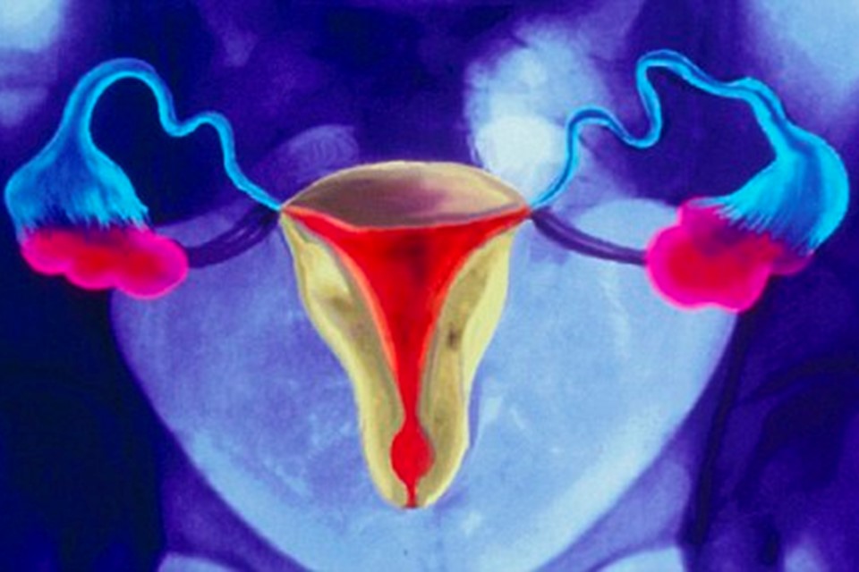 Tiny sling correcting uterine prolapse spares women trauma of hysterectomy