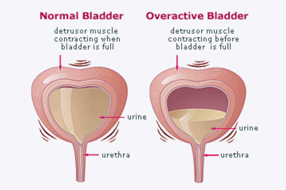 Urge Incontinence diagram