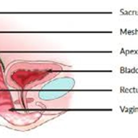 The Sacrohysteropexy Procedure: Everything You Need to Know