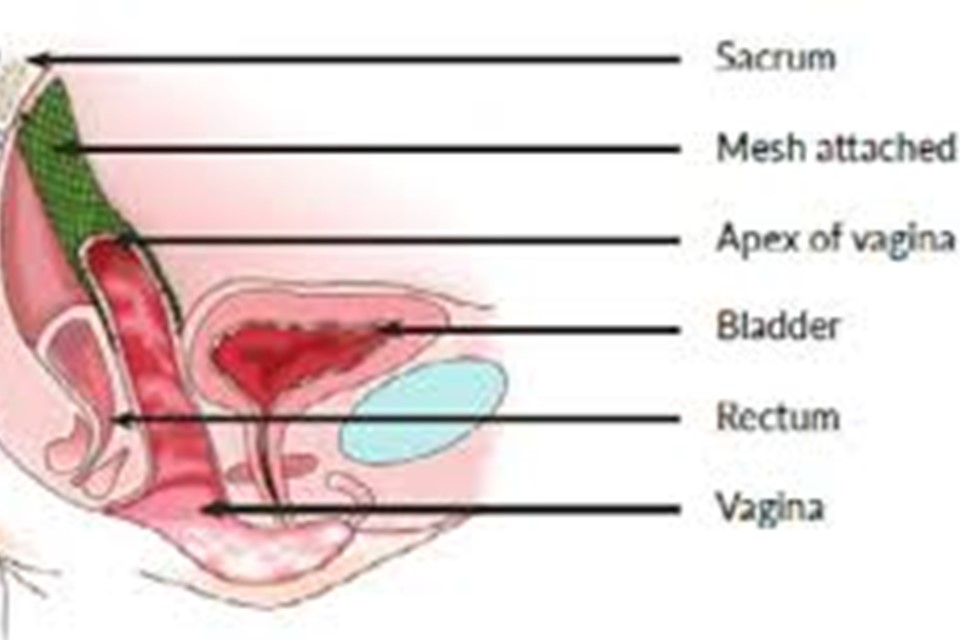 The Sacrohysteropexy Procedure: Everything You Need to Know