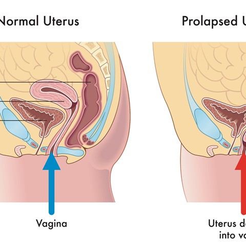 How is a Prolapsed Uterus Treated?