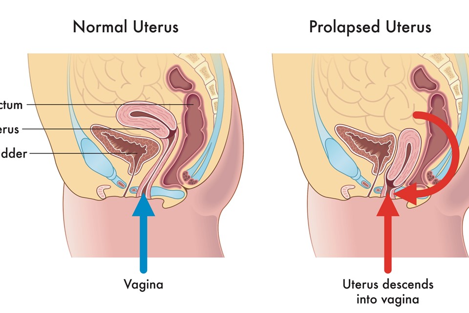 How is a Prolapsed Uterus Treated?