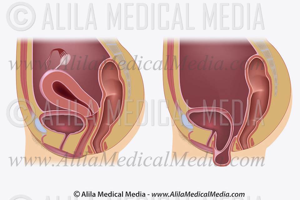 Uterine prolapse occurs when the uterus drops into the vagina. Uterine  prolapse occurs when the pelvic muscles and ligaments that suppor