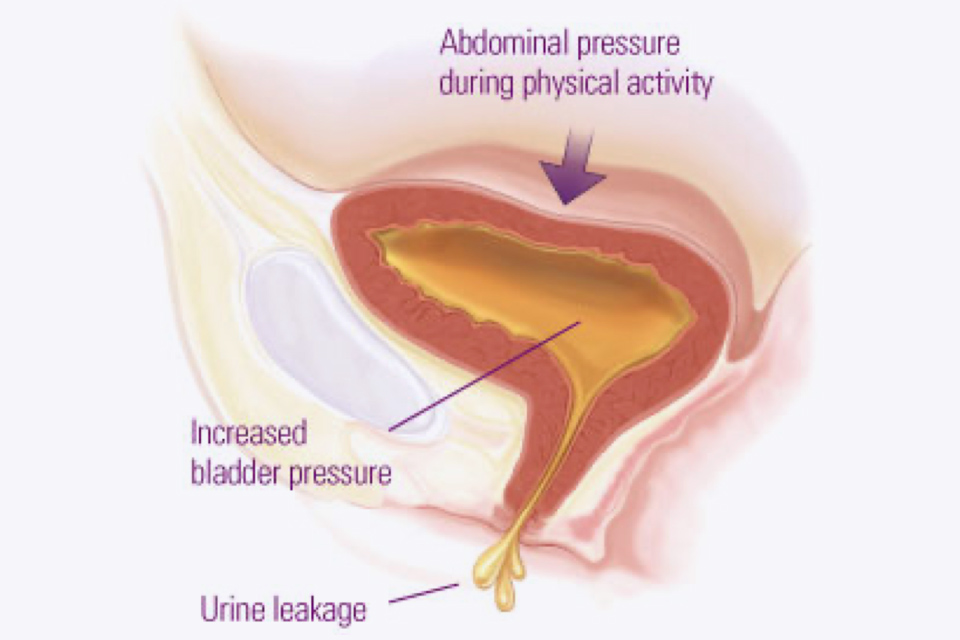 Stress urinary incontinence  PPT