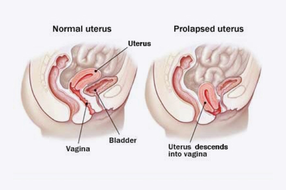 Uterine prolapse. (left) Lateral view of pelvis showing normal pelvic ß