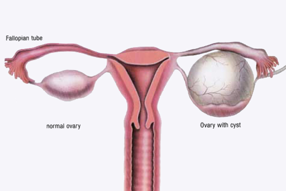 Ovarian Cysts diagram