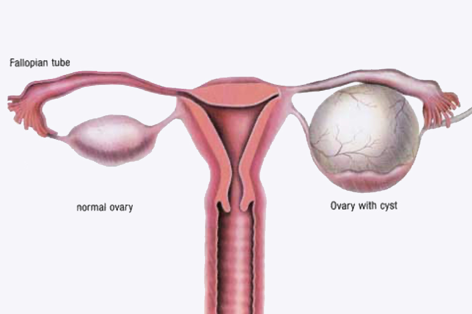 ovarian cyst rupture