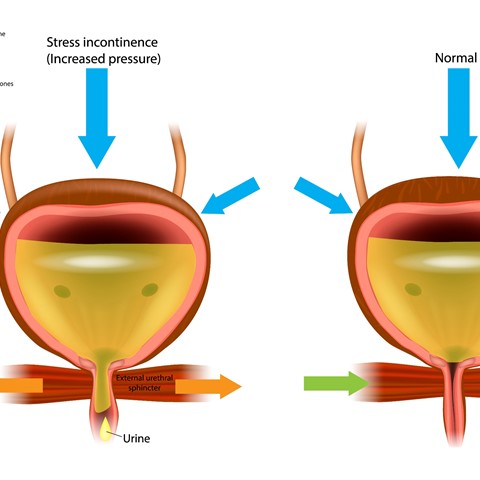 What is Stress Incontinence?