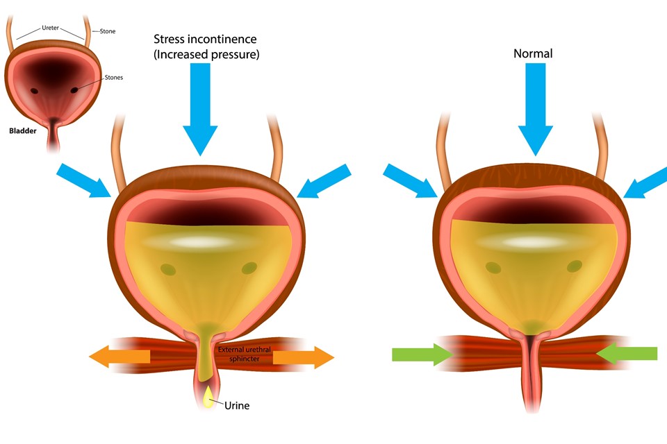What is Stress Incontinence?
