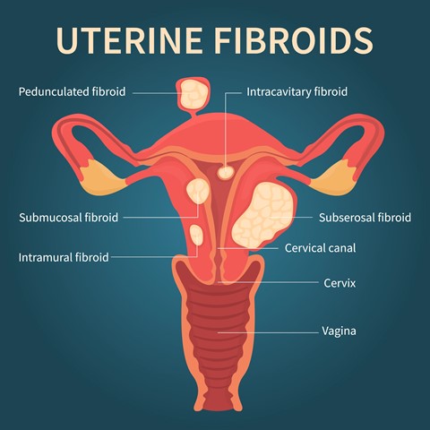 What Causes Uterine Fibroids to Grow After Menopause?
