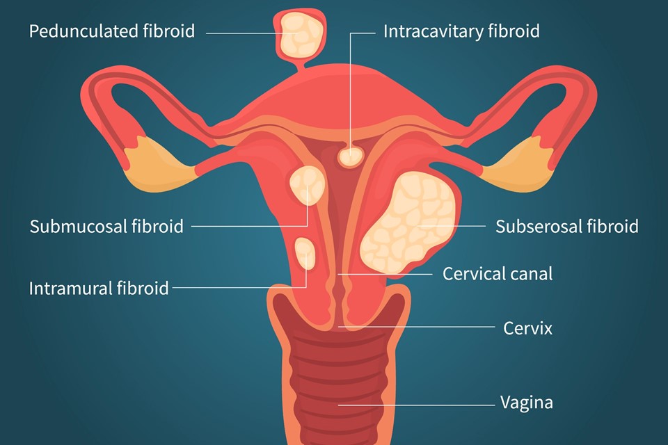 What Causes Uterine Fibroids to Grow After Menopause?